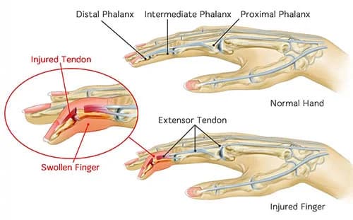Hand injuries treatment doctor specialist NYC — Dr. Febin Melepura
