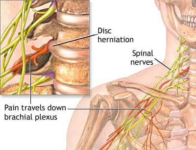 Person with neck pain from prolonged phone and screen use