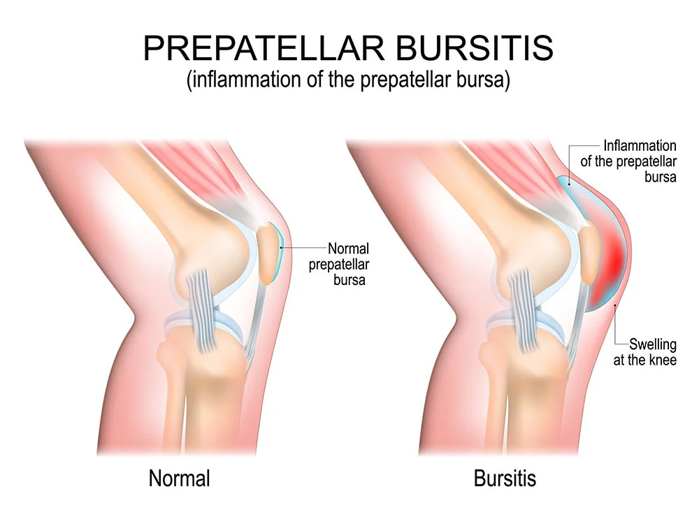 Knee pain after working out — 11 potential causes — SPIN NYC