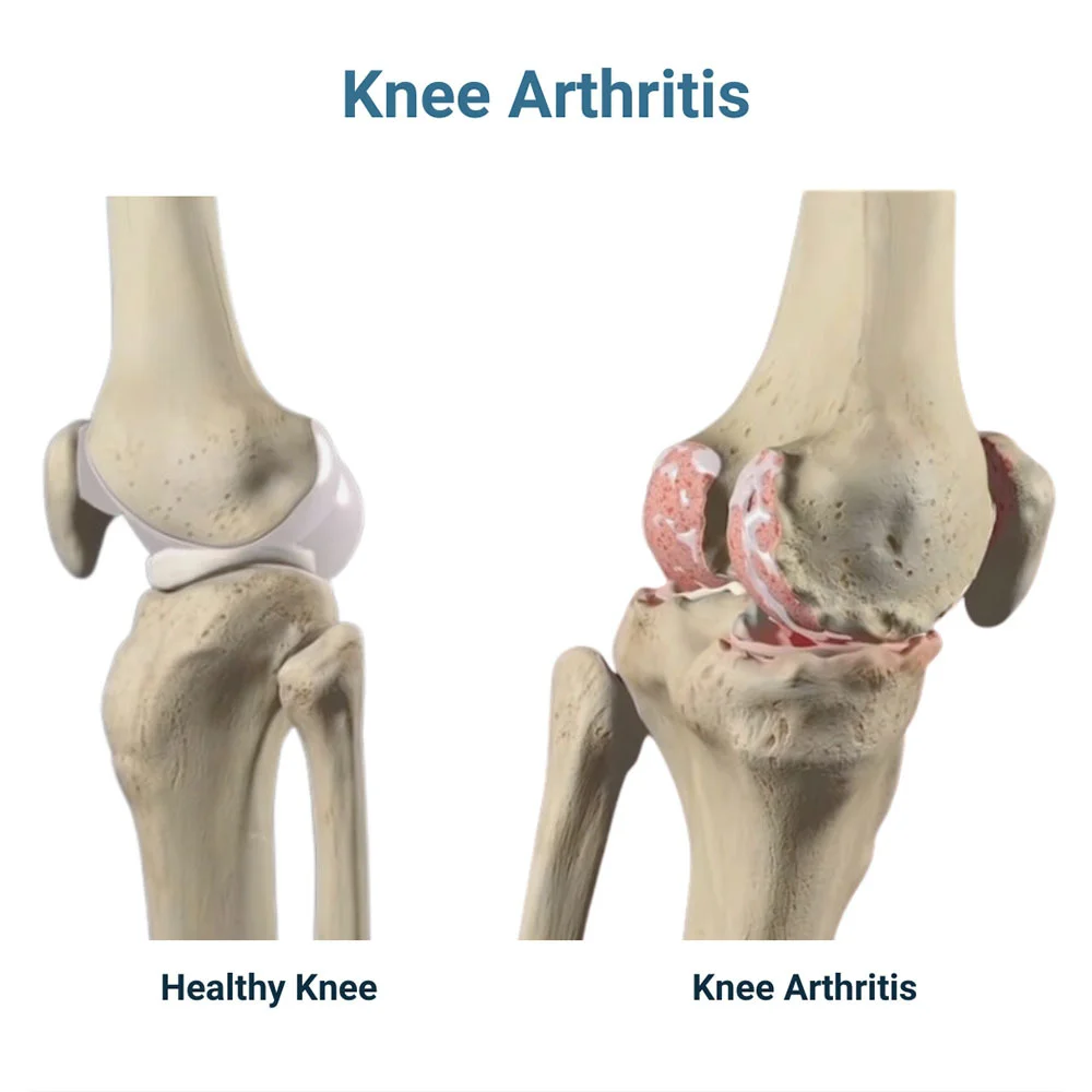 Knee pain when bending and straightening — SPIN NYC