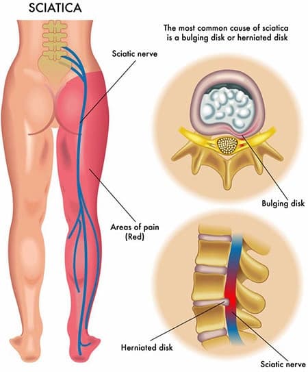 Anatomical illustration of the lower lumbar spine — SPIN NYC