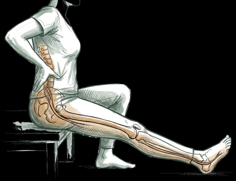Illustrated diagram of sciatica nerve pain running from the lower spine through the buttock and down the leg