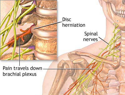 Cervical spine anatomy showing disc herniation, spinal nerves, and brachial plexus — neck pain treatment NYC