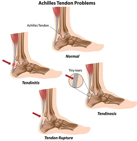 Ankle injuries treatment doctor specialist NYC — Dr. Febin Melepura