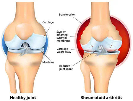 Knee arthritis treatment at Sports Pain Institute NYC — Dr. Febin Melepura