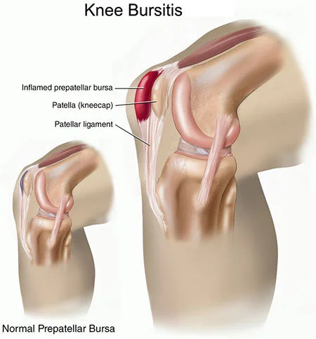 Knee bursitis treatment doctor specialist NYC — Dr. Febin Melepura
