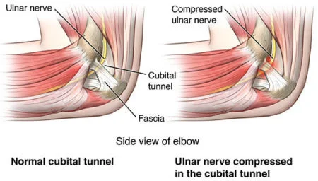 Cubital tunnel syndrome treatment doctor specialist NYC — Dr. Febin Melepura