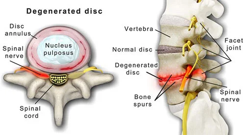 Degenerative disc disease treatment doctor back specialist NYC — Dr. Febin Melepura