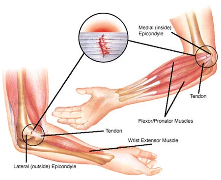Elbow pain treatment at Sports Pain Institute NYC — Dr. Febin Melepura
