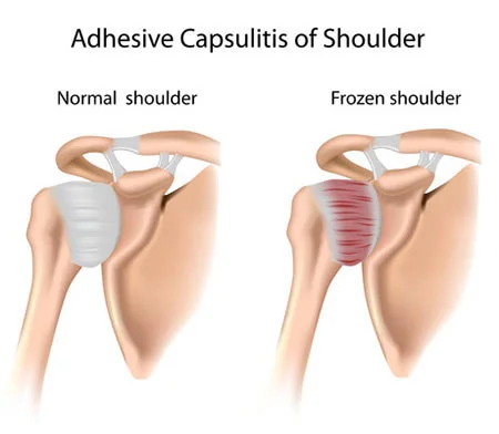 Frozen shoulder treatment doctor specialist NYC — Dr. Febin Melepura
