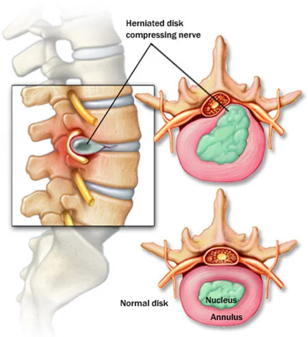 Herniated discs treatment doctor specialist NYC — Dr. Febin Melepura