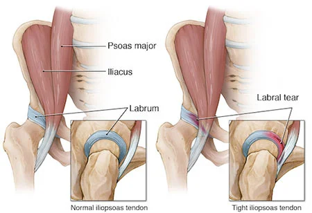 Hip labral tear treatment at Sports Pain Institute NYC — Dr. Febin Melepura
