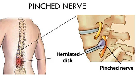 Pinched nerve in back treatment at Sports Pain Institute NYC — Dr. Febin Melepura