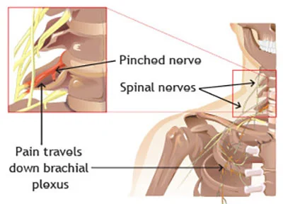 Pinched nerve in neck treatment at Sports Pain Institute NYC — Dr. Febin Melepura