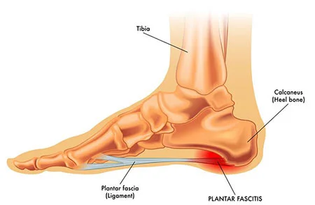 Plantar fasciitis treatment doctor specialist NYC — Dr. Febin Melepura