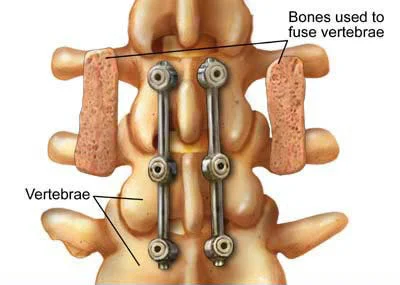 Post-laminectomy syndrome treatment doctor specialist NYC — Dr. Febin Melepura