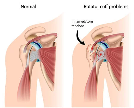 Rotator cuff injury treatment doctor specialist NYC — Dr. Febin Melepura