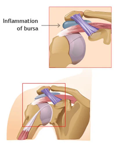 Shoulder bursitis treatment doctor specialist NYC — Dr. Febin Melepura
