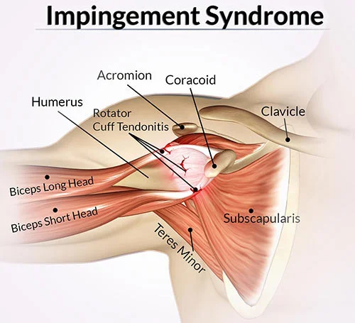 Shoulder impingement treatment at Sports Pain Institute NYC — Dr. Febin Melepura