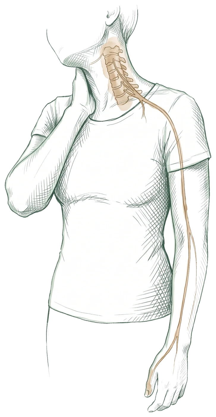 Hand-drawn sketch of a person holding the side of their neck, with the cervical spine and a pinched nerve traced from the neck down the arm to the thumb and fingers