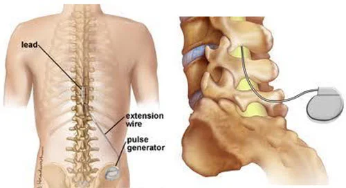 Spinal cord stimulation therapy for chronic back pain at Sports Pain Institute NYC — Dr. Febin Melepura
