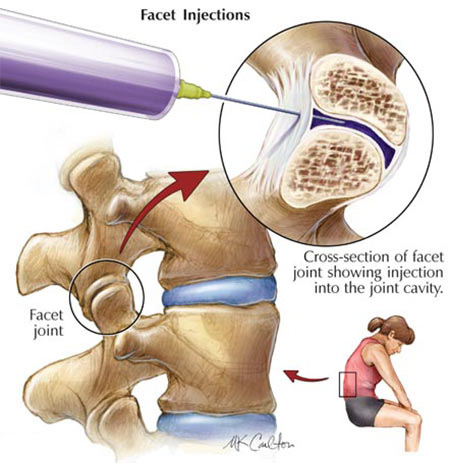 Facet Injections illustration showing cross-section of facet joint and injection into the joint cavity