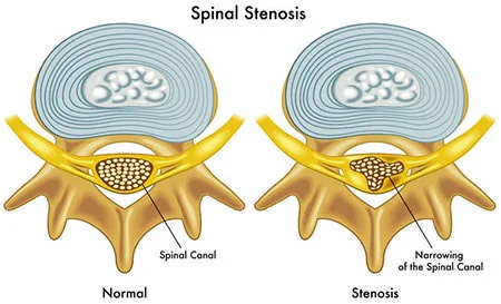 Spinal stenosis treatment doctor spine specialist NYC — Dr. Febin Melepura
