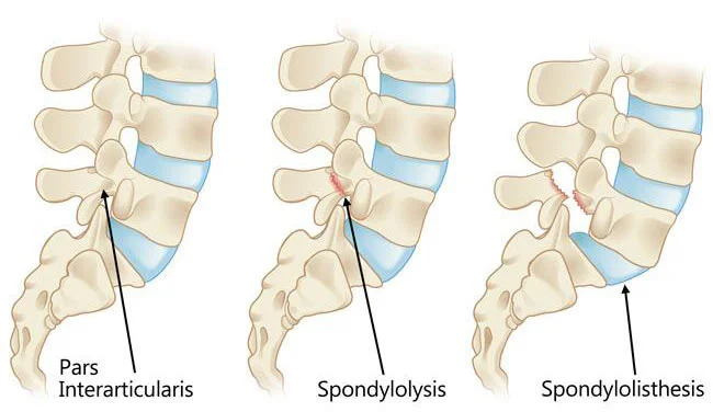 Spondylolisthesis treatment doctor back specialist NYC — Dr. Febin Melepura
