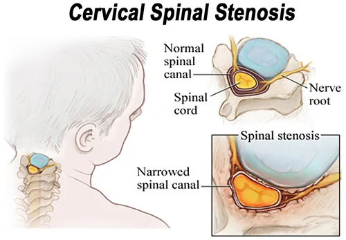 Stenosis of the neck treatment at Sports Pain Institute NYC — Dr. Febin Melepura