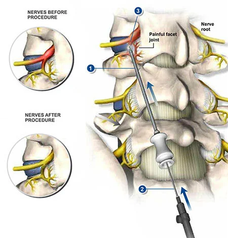 Sympathetic nerve block injection for lower back pain at Sports Pain Institute NYC — Dr. Febin Melepura