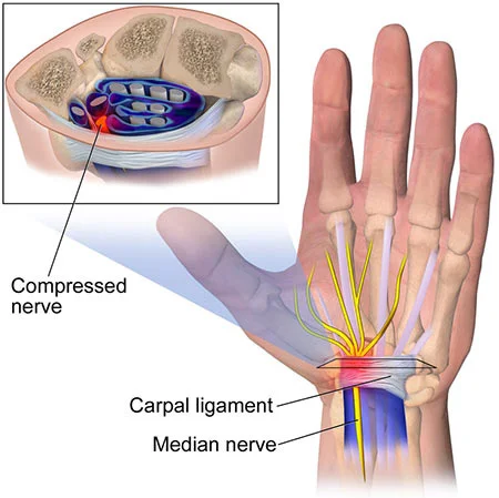 Wrist injury treatment doctor specialist NYC — Dr. Febin Melepura