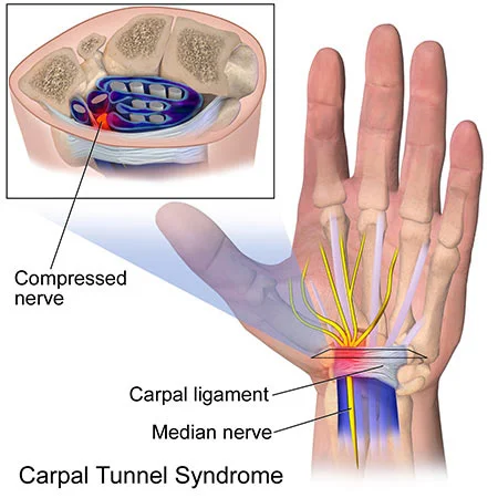 Wrist pain treatment doctor specialist NYC — Dr. Febin Melepura