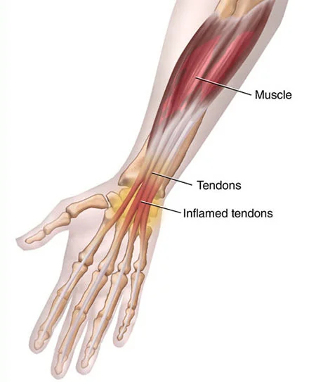 Wrist tendonitis treatment doctor specialist NYC — Dr. Febin Melepura