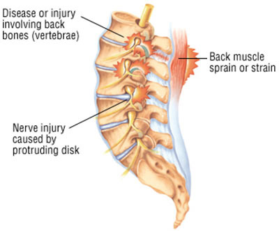 Back Sprain Treatment Doctor in NYC, Back Pain Specialist