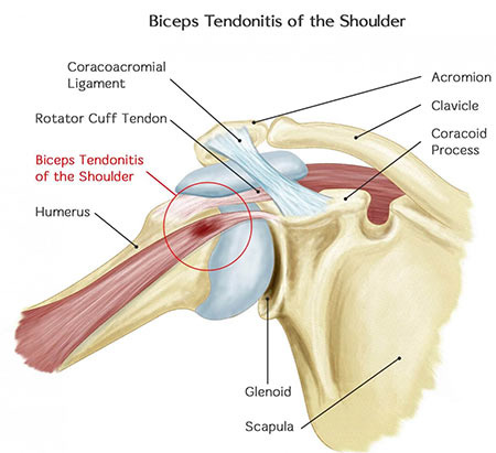 Bicep Tendonitis Treatment Doctor in NYC, Pain Specialist