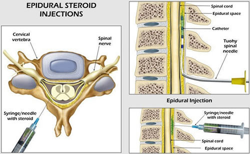 steroid injection in the spine
