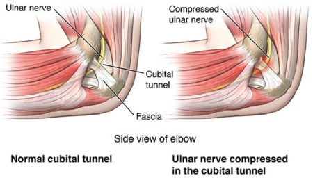 Cubital Tunnel Syndrome Treatment Doctor in NYC, Elbow Specialist