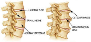 Neck Degenerative Disc Disease Treatment NYC | Neck Osteoarthritis ...