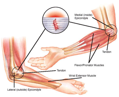 Elbow Pain Treatment NYC