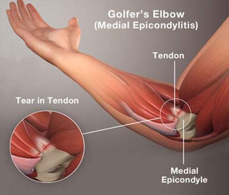 Golf Elbow Treatment