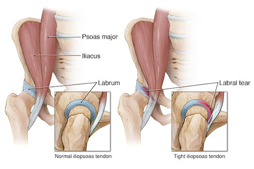 Hip Tendonitis Treatment