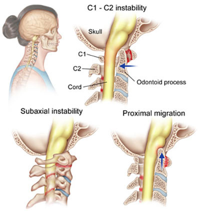 Cervical osteochondrosis c5 6, Osteochondrosis neck pain