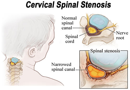 Stenosis of the Neck Treatment Doctor in NYC, Neck & Spine Specialist