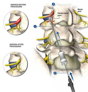 nerve sympathetic chronic injections lumbar spinal lower