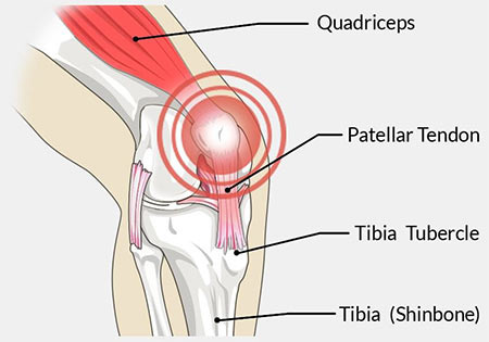 Patellar Tendonitis Treatment Doctor Knee Specialist in NYC