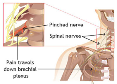 hoste sød smag hjemme Pinched Nerve in Neck Treatment in New York City