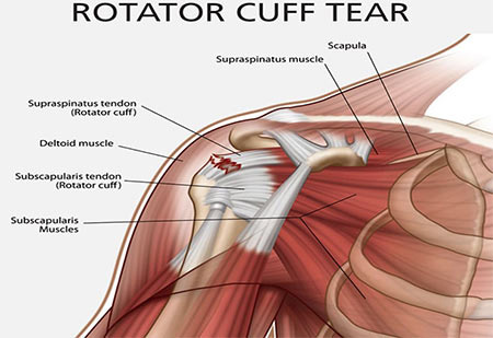 Rotator Cuff Tear Treatment Doctor in NYC, Shoulder Specialist