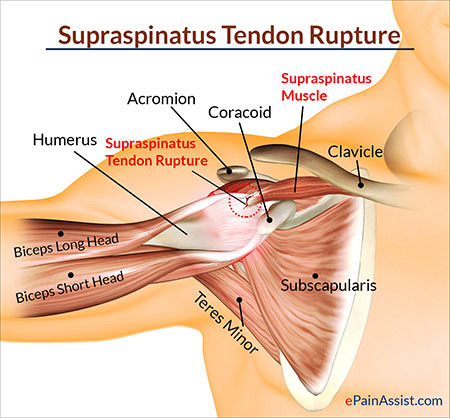NYC Shoulder Tendonitis Treatment Doctor Specialist · Sports Pain Management Clinic