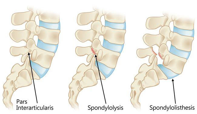 Spondylolisthesis Treatment Doctor in NYC, Back Pain Specialist