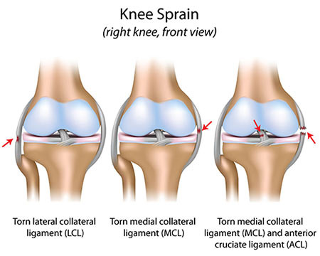 Sprained Knee Treatment